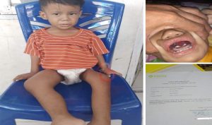 Infeksi Tulang dan Tumor Gusi, Bocah 3 Tahun Butuh Bantuan